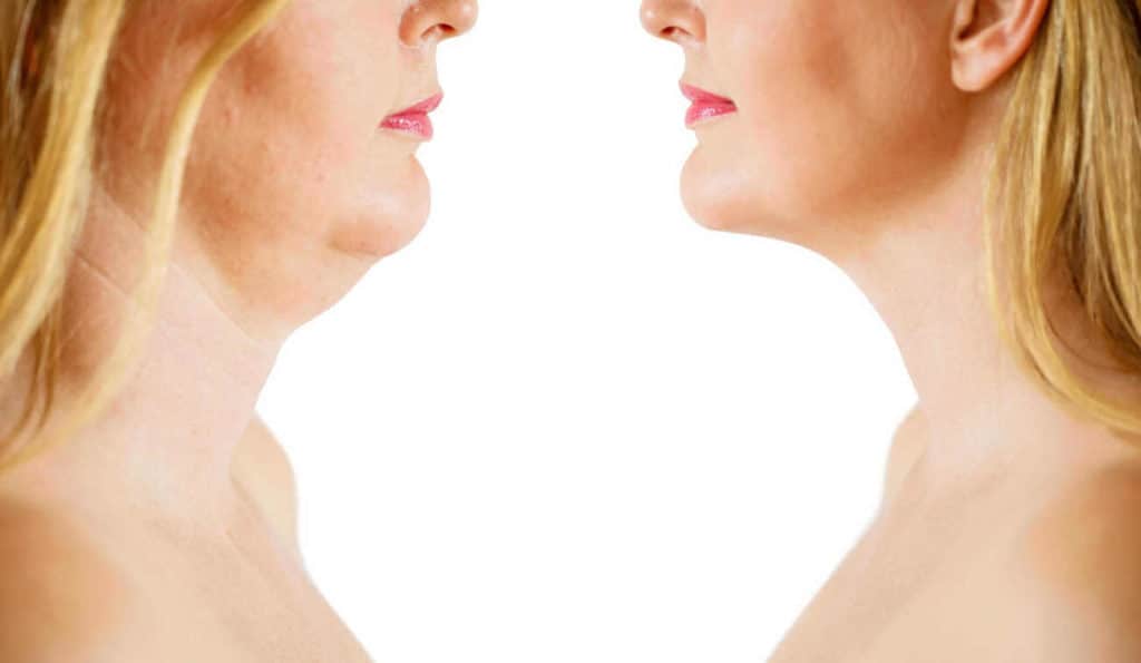Double Chin treatment Manchester before and after results