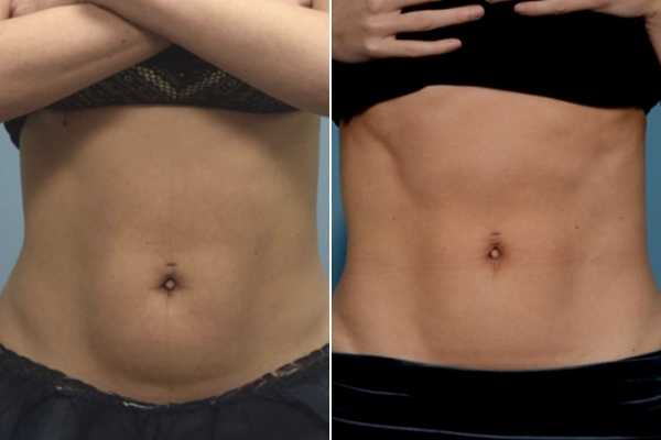 body sculpting FAQs Manchester