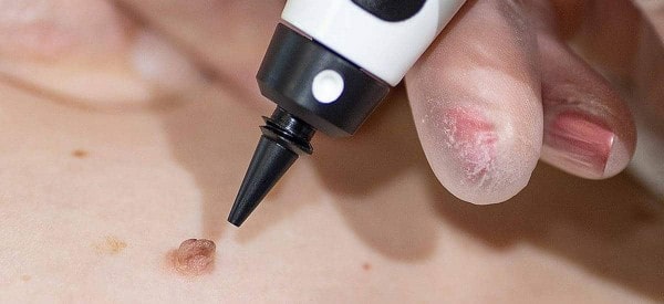 After Skin Tag Removal Manchester