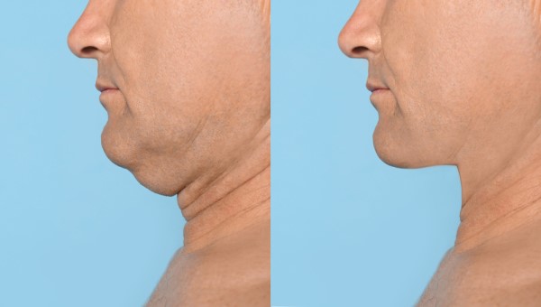 Which Non-Surgical Treatments Work Best for Jowls and Loose Skin Manchester?