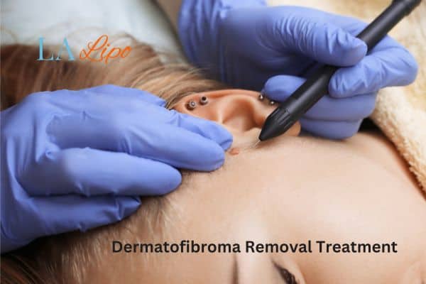 Dermatofibroma Removal Treatment Manchester