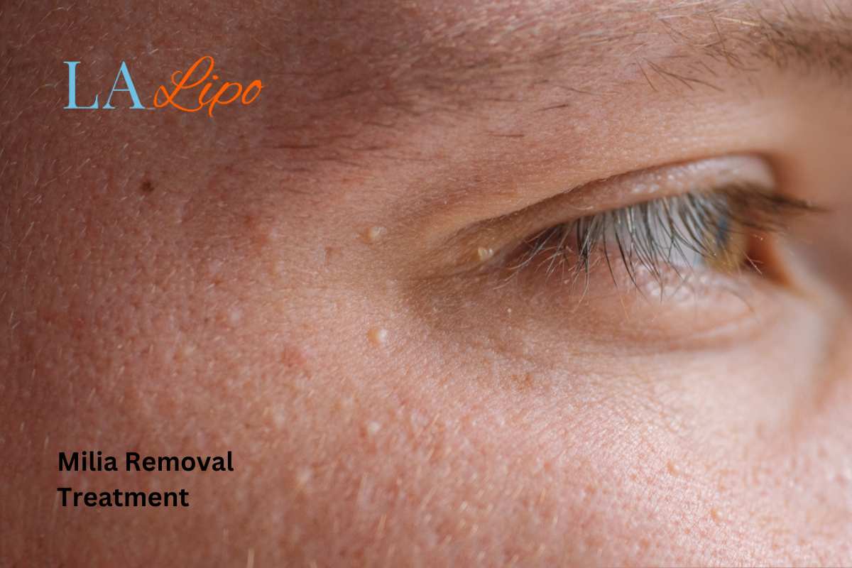 Cryopen Milia Removal: Is It the Easiest and Safest Option Manchester?