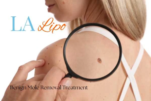 Woman having her inspection of blemish before mole removal Manchester