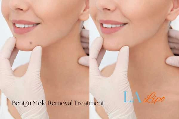 woman's before and after mole removal Manchester results
