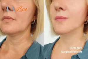 hi-fu for wrinkles Manchester before and after results