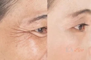 Before and after results of woman - HI-fu wrinkles reduction treatment Manchester