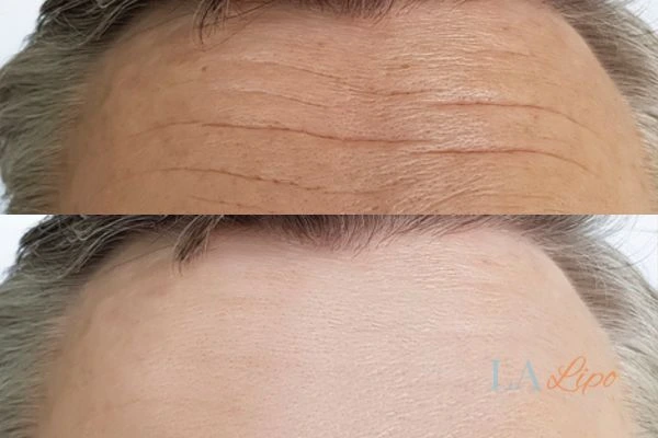 results of HIFU Manchester on mans forehead to help reduce lines and wrinkles