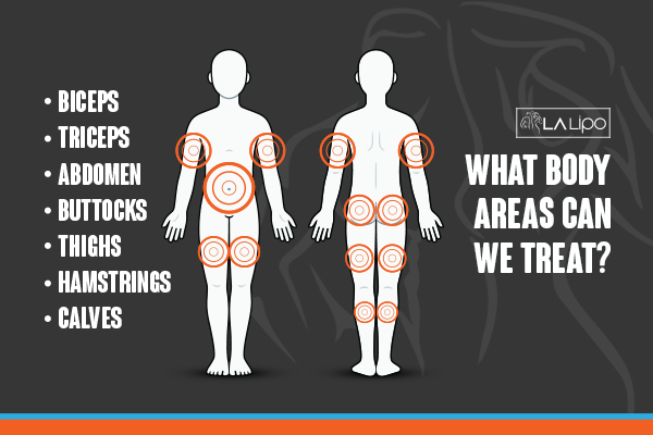 Graphic to show areas you can have LA-EMS Body Sculpting Manchester treatment.