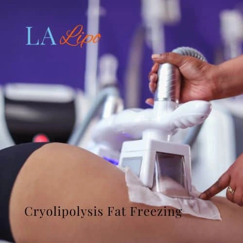 fat freezing - Cryolipolysis Manchester