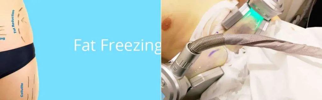 Fat freezing Manchester on multiple areas of the body
