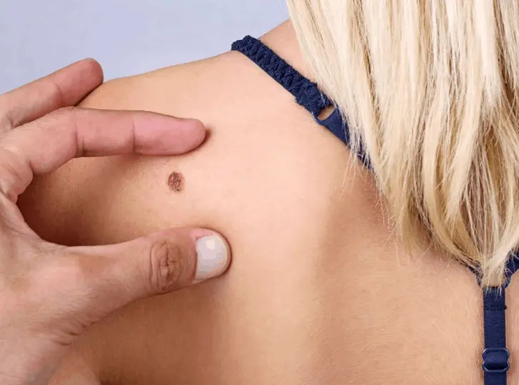 woman having mole removal Manchester consultation before treatment.