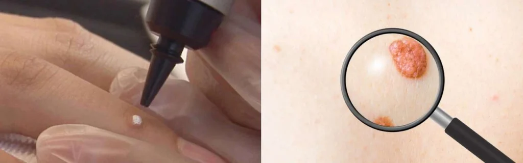 Person getting moles removed with cryopen Manchester