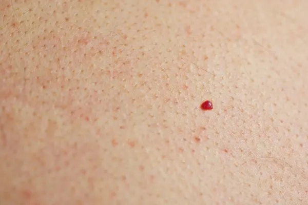 close up of a cherry angioma Manchester
