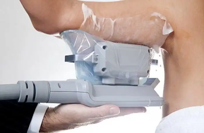 Picture of fat freezing Manchester on the upper arms.