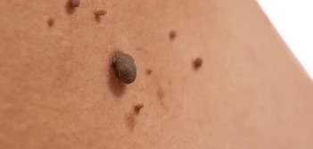 image of a skin tag Manchester