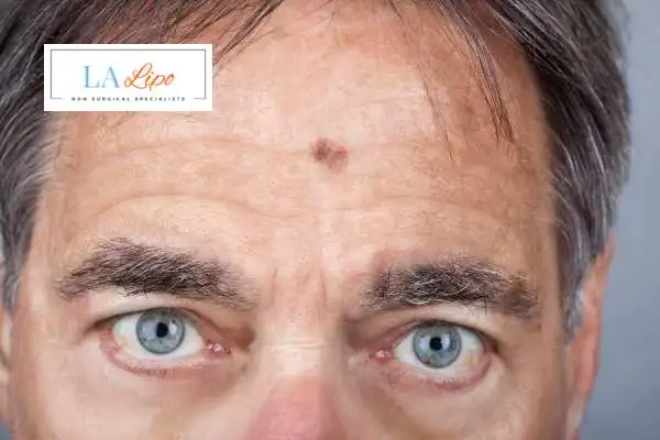 Solar Lentigo Removal Manchester image of man with mark on his forehead