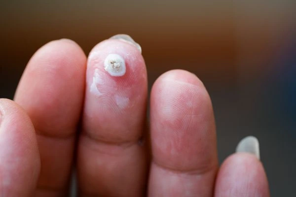wart on person finger - cryotherapy to treat from LA LIPO Manchester