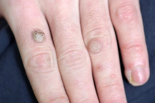 photo of warts on person hand - see wart removal Manchester from LA LIPO