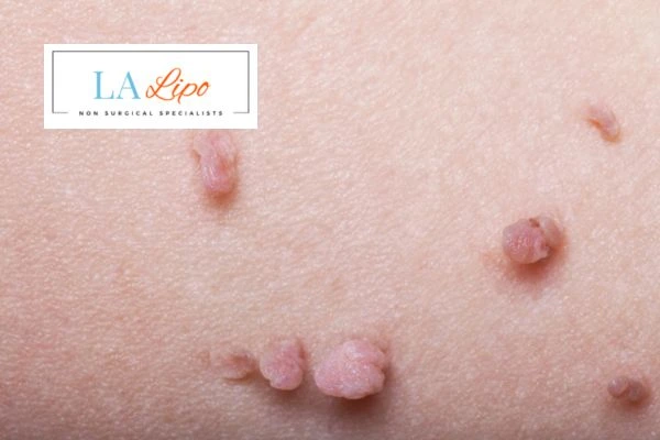 Does cryopen skin tag removal Manchester hurt? Find out now call our team today!
