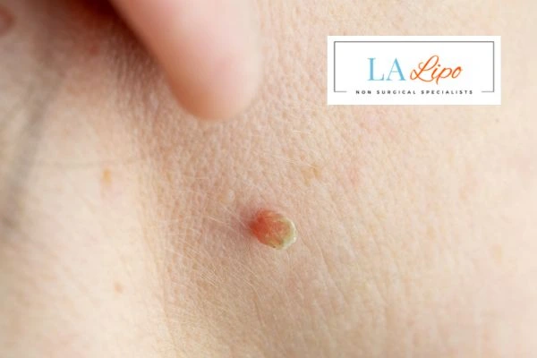 Book skin tag removal Manchester today speak to our team now!