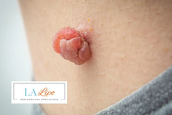 Interested in skin tag removal Manchester? Concerned about the pain? Find out more today!