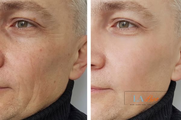 See the amazing results of Morpheus8 Treatment Manchester!