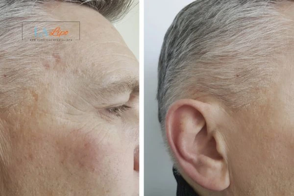 Mens Before & After Morpheus 8 Results Manchester