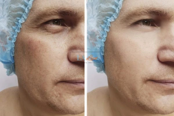 Before and after Morpheus 8 Results Manchester