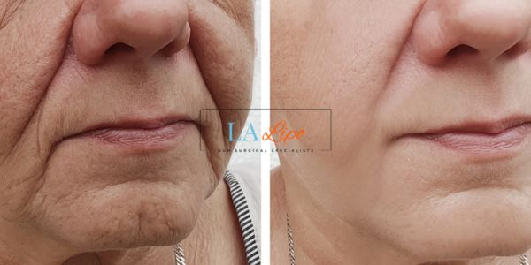 Older lady deeper wrinkle reduction - LA LIPO Morpheus 8 Results Manchester