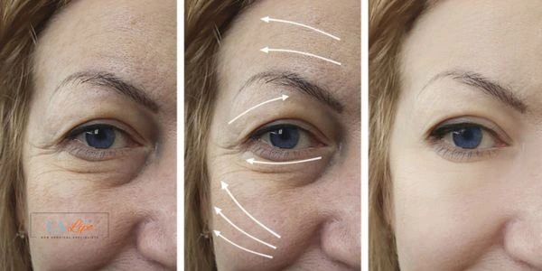 Amazing eye lift Morpheus 8 results Manchester