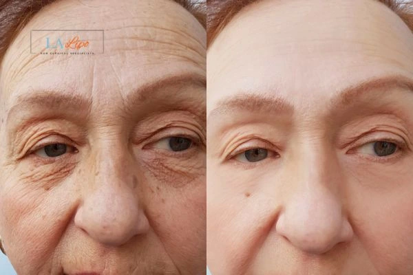The powerful benefits of Morpheus8 Treatment Manchester - Call Our team today!