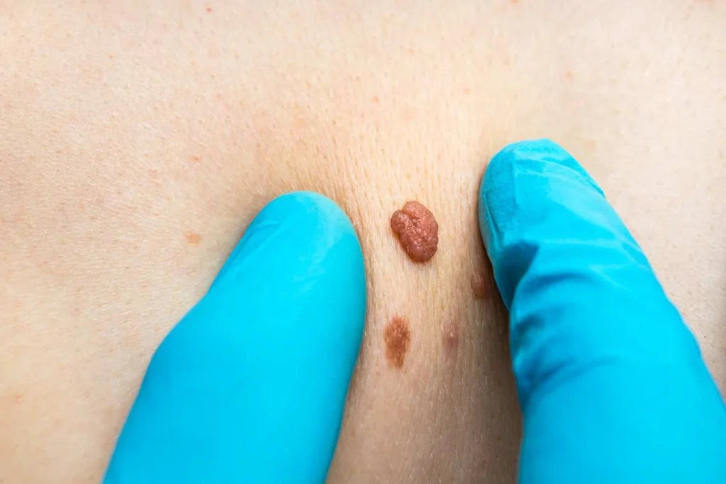 LA LIPO Cryopen Lesion Removal Prices Manchester