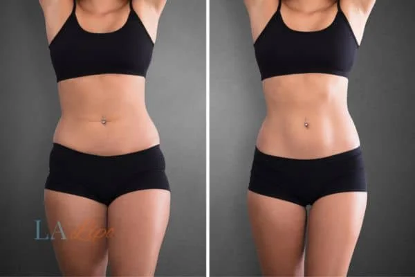 before and after results of non-surgical treatment to help a woman's body image and mental health Manchester