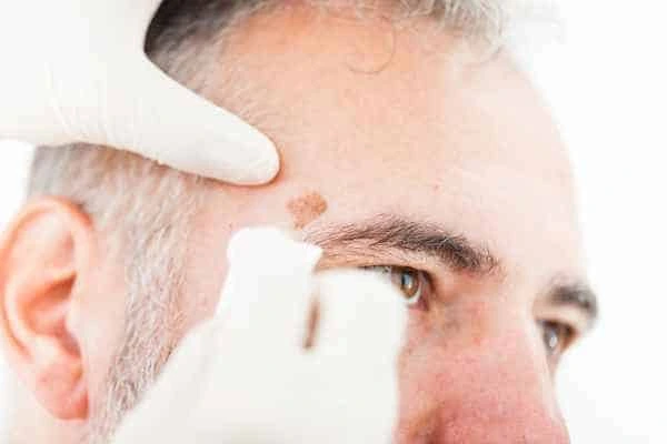Age spots and elderly people Manchester what is the link?