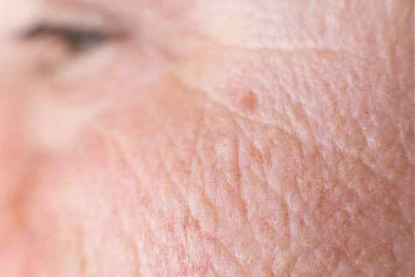 close up picture of a woman's face showing an age spot Manchester