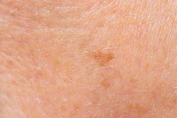 close up picture of age spots Manchester