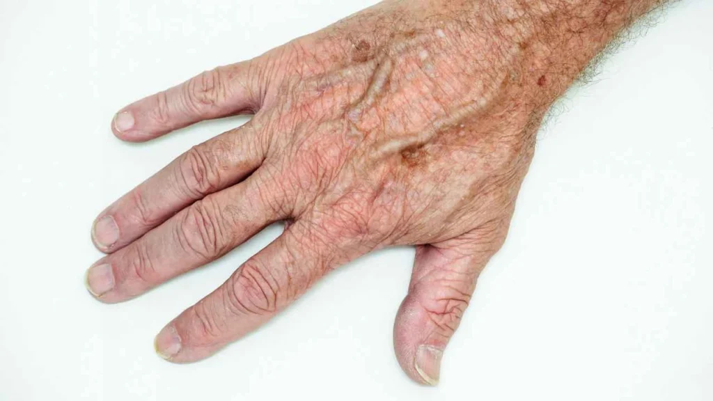 Male hand showing age spot Manchester