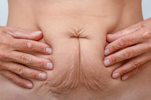 Image of a woman's stomach with loose skin - example of skin tightening Manchester options