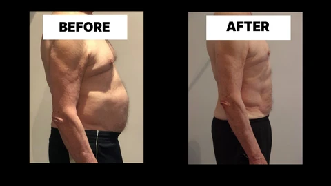 What Symptoms Can Diastasis Recti Cause in Men? Weak Core, Back Pain and Poor Posture Manchester